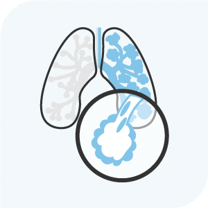 COPD(慢性閉塞性肺疾患)